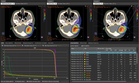 Examples of BNCT treatment planning